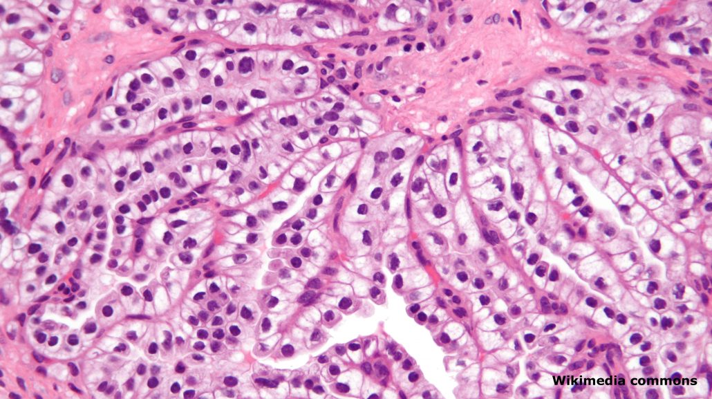 Diabete tipo 2: vitamina D3 e acidi grassi omega-3 non migliorano la  funzionalità renale - Newence