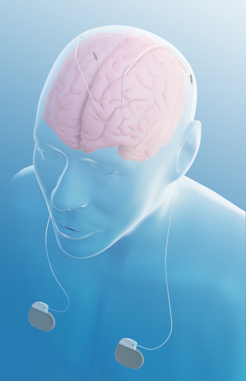 Deep brain. Нейростимулятор мозга. Глубокая стимуляция мозга DBS. Нейростимулятор на голову.